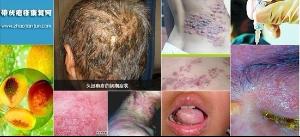 带状疱疹的患病原因 - 搜搜百科