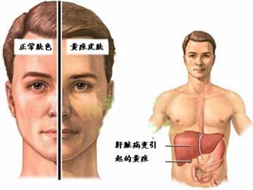 关于王敏主任医师治疗黄疸经验的学士学位论文范文