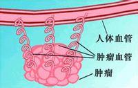 肿瘤血管阻断疗法