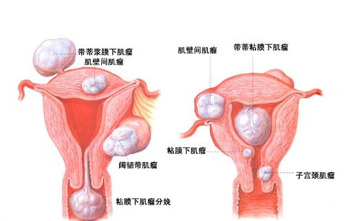 子宫肌瘤+-+搜搜百科