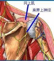 冈上肌肌腱炎