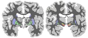pallidus),丘脑下核(subthalamic nucleus)和 黑质(sn,红色所示)右边