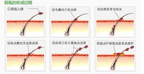 在人体寄生的<em>虱子</em>有3种,即头虱