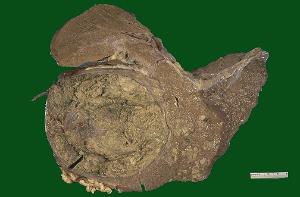 肝硬化腹水晚期