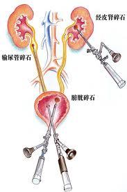 中老年人泌尿系统感染 - 搜搜百科