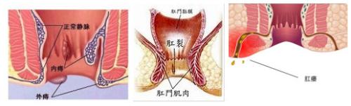 便秘,肛瘘,肛裂
