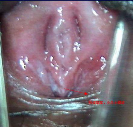 处女生繁器高清大图图片_处女膜闭锁