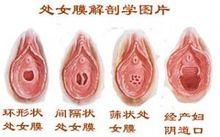 处女膜修补手术