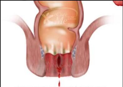 肛裂的临床症状表现为疼痛和出血