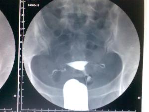 全维微管无痛人流术