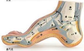 劳损,导致足部疼痛发炎的一种病症,其多见脚跟处,足底部,或脚背等部位