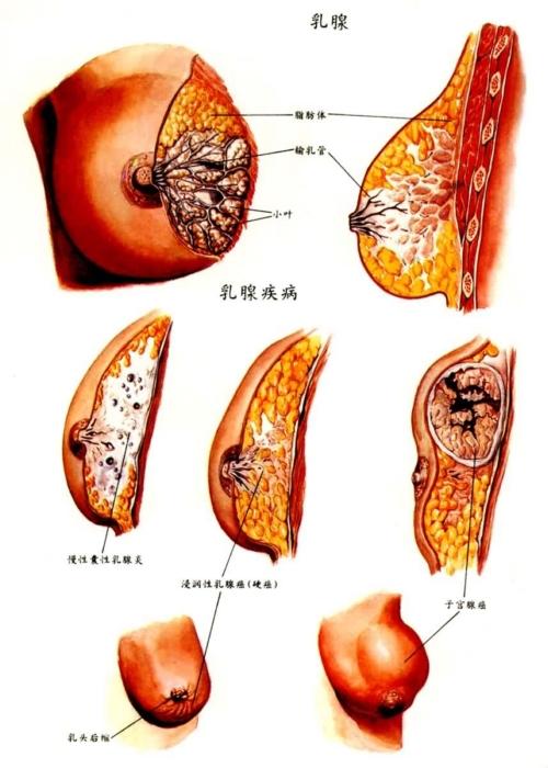 女性乳腺疾病