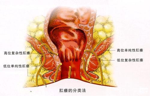 肛瘘是什么病