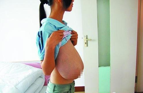 乳腺畸形+-+搜搜百科