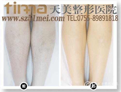 激光脱毛前后对比图