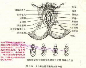 先天性处女膜闭锁症