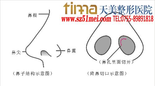 软骨隆鼻