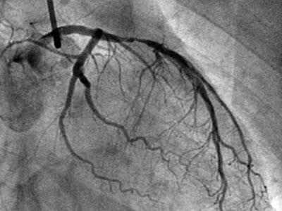 冠状动脉造影术