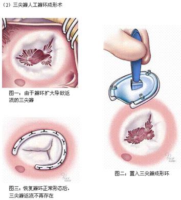 三尖瓣成形术