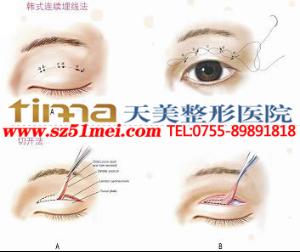 双眼皮过宽或过窄;弧度中断