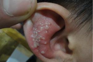 耳部疱疹 疱疹快速好的方法有没有?