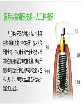 人工种植牙