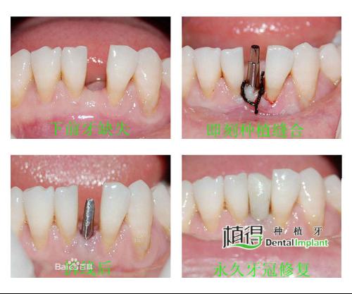 由于采取在患者新鲜的拔牙创口立即植入种植体