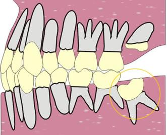 埋伏牙+-+搜搜百科