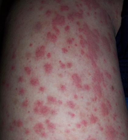 过敏性紫癜又称出血性毛细血管中毒症或heno