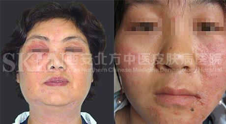 皮肤过敏症状+-+搜搜百科