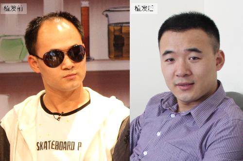 自体毛发移植+-+搜搜百科