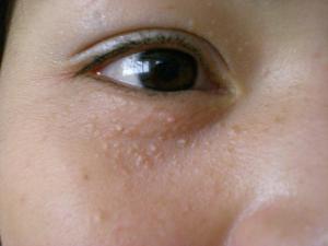 眼部扁平疣是什么因素引起的呢?有图片说明么?
