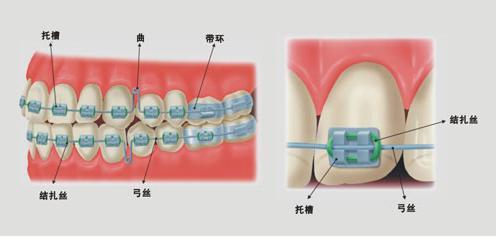 壹加壹钢丝 矫正 所采用的钢丝 牙套 是由一种高强