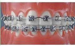 project introdution 钢丝矫正用一种专用黏结剂来固定在牙齿表面的