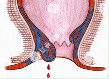 痔疮便血(hemorrhoids hematochezia )主要是内痔出血,多在排大便后