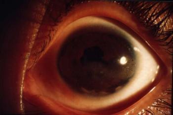 葡萄膜炎+-+搜搜百科