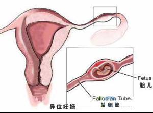 宫外孕流产