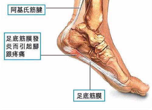 跟痛症+-+搜搜百科