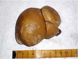 双肾结石+-+搜搜百科