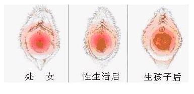 诊断靠阴道指诊:处女膜环容一指或两指受阻