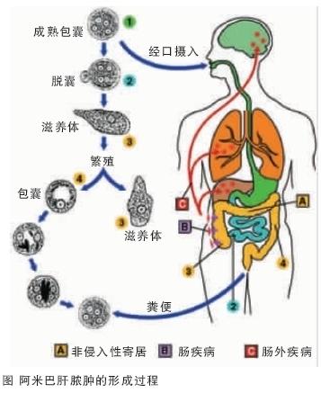 阿米巴肝脓肿