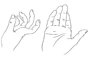 手指扭伤,手指强力背屈等可引起掌指关节脱位,多见于拇指和示指.