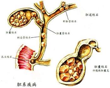 胆结石在胆囊内形成后,可刺激胆囊粘膜,不仅可引起胆囊的慢性炎症