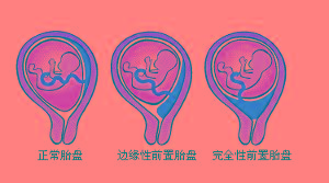 导致前置部分的胎盘自其附着处剥离,使血窦破裂而出血