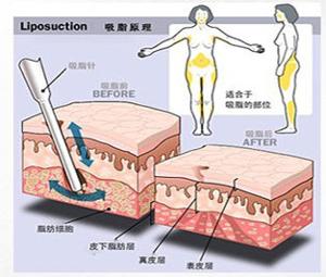 在面部吸脂对比