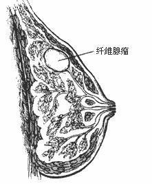 乳腺纤维腺瘤是否会恶变,是许多患者最关心的问题,也是临床医生所关心