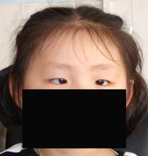 是儿童斜视的 是儿童斜视的