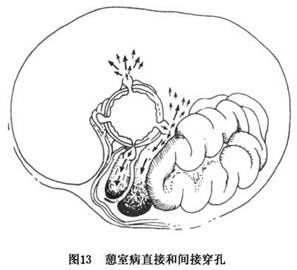 小肠瘘