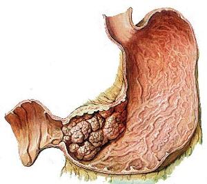 胃癌的中晚期症状常因肿瘤的生长部位,类型,大小,病程的早晚,有无