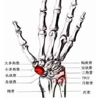 月状骨骨软骨病